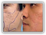 acne-scar-therapy_1_3165