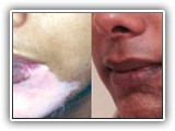 viltigotreatment01